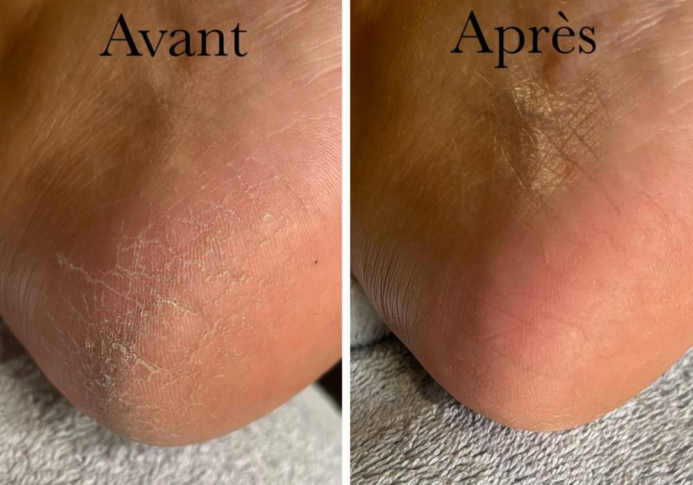 Soins des pieds - Calluspelling